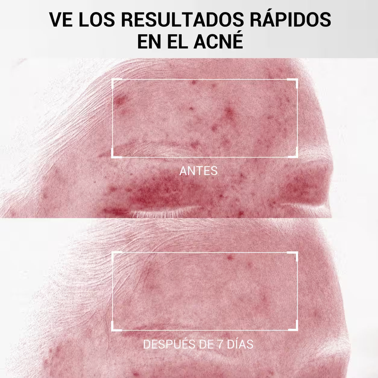 Acne Zero Dr.Leo: Menos granos, más confianza cada dia