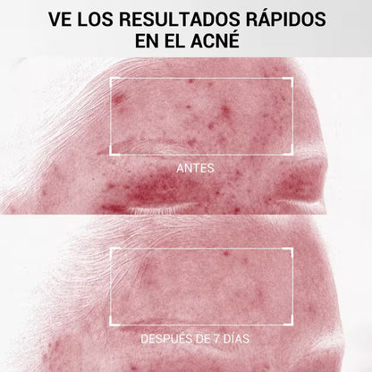 Acne Zero Dr.Leo: Menos granos, más confianza cada dia
